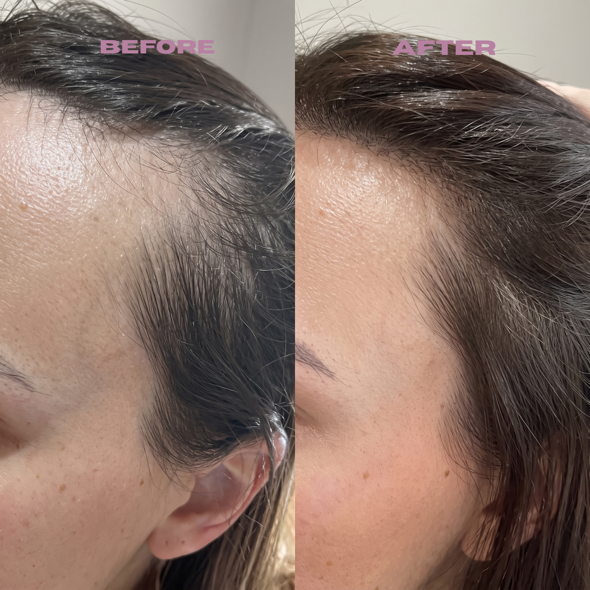Rosemary PDRN Scalp Serum – Root Strengthening & Hair Revitalizing