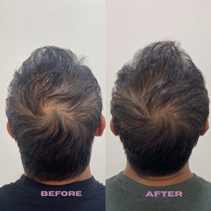 Rosemary PDRN Scalp Serum – Root Strengthening & Hair Revitalizing